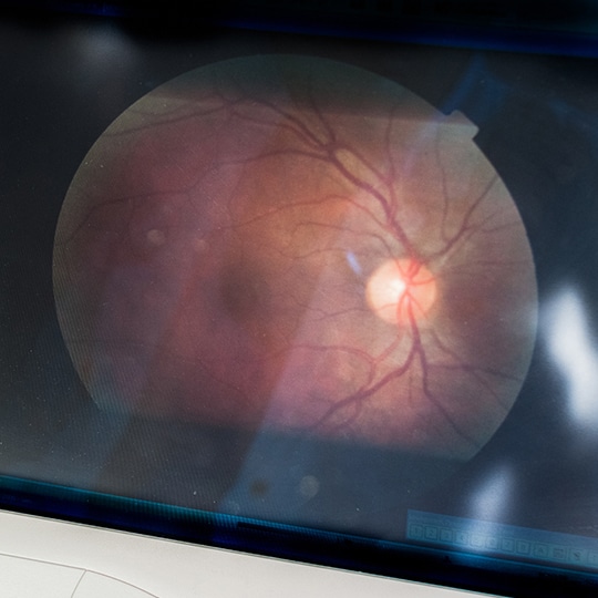 Retina Diseases at Metro EYE MD Queens NY